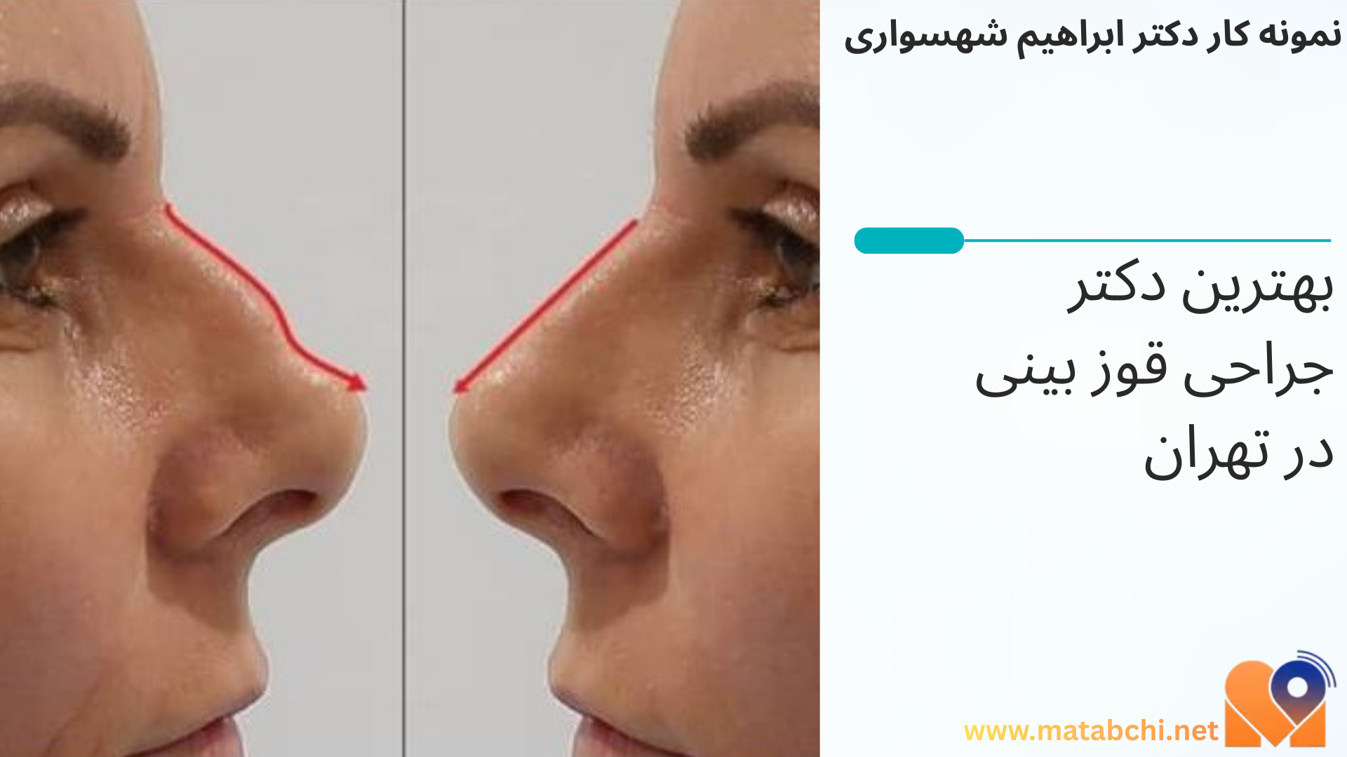 نمونه کار دکتر دکتر ابراهیم شهسواری   برای جراحی قوز بینی