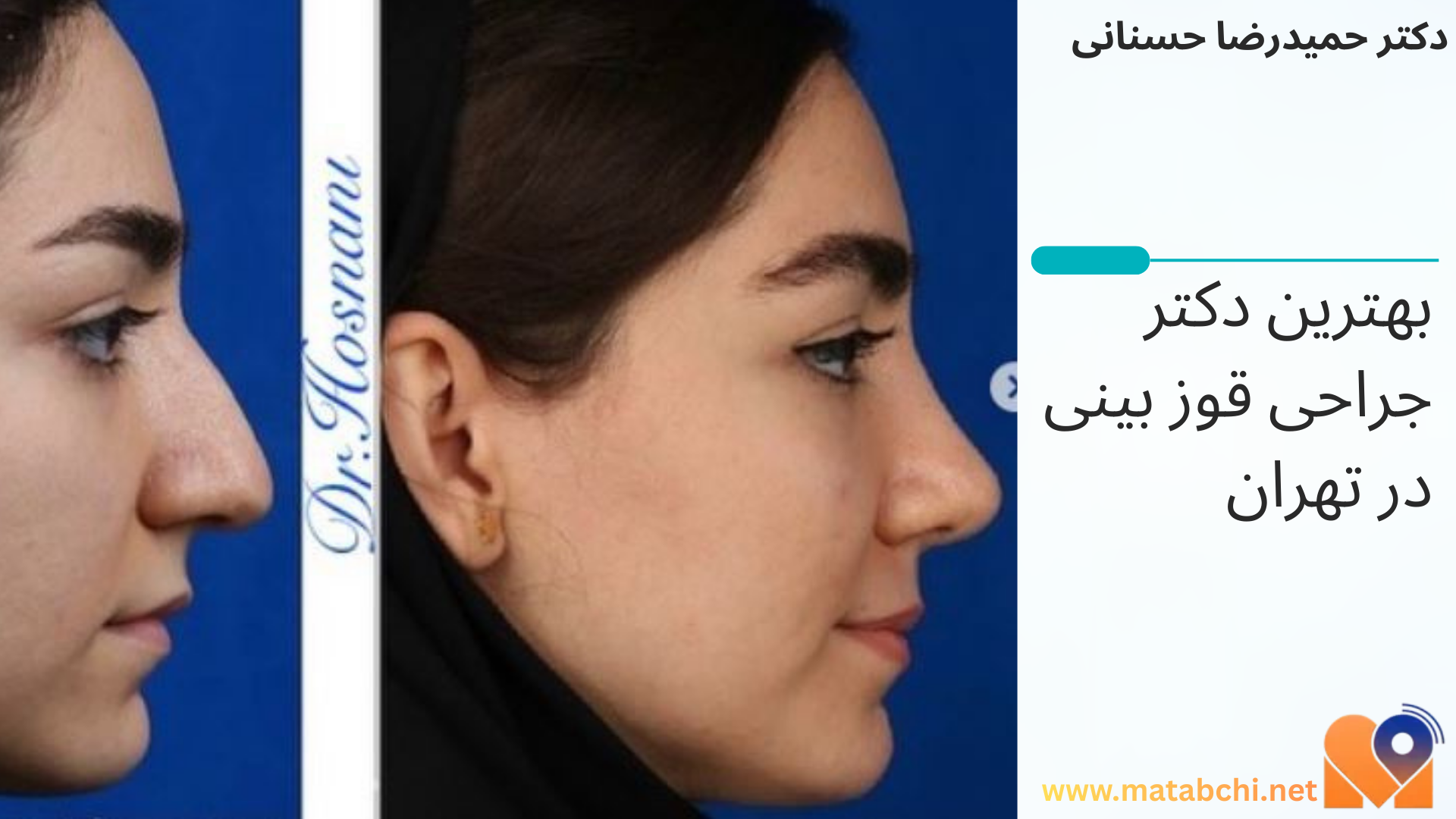 نمونه کار دکتر حمیدرضا حسنانی برای جراحی قوز بینی