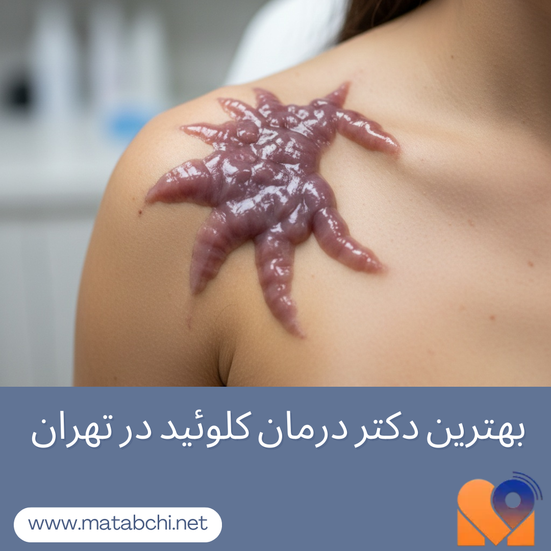 بهترین دکتر برای درمان کلوئید در تهران