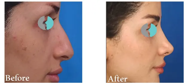 عکس جراحی بینی نیمه فانتزی دکتر حمیدرضا حسنانی
