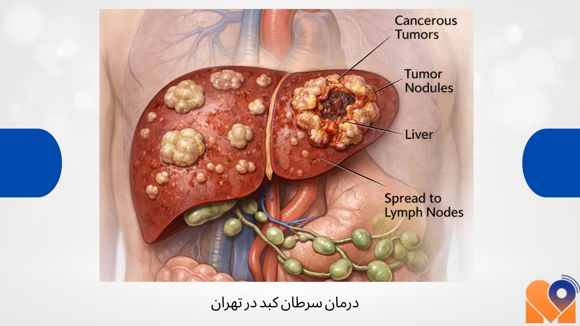 درمان سرطان کبد در تهران