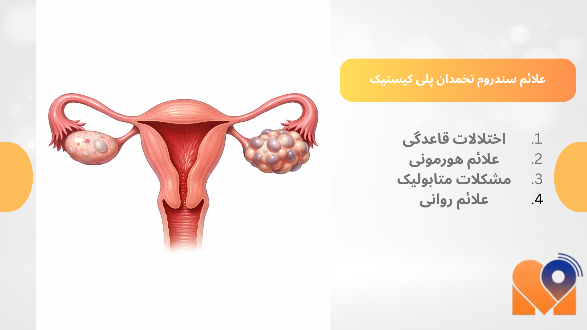 علائم سندروم تخمدان پلی‌ کیستیک در یک نگاه