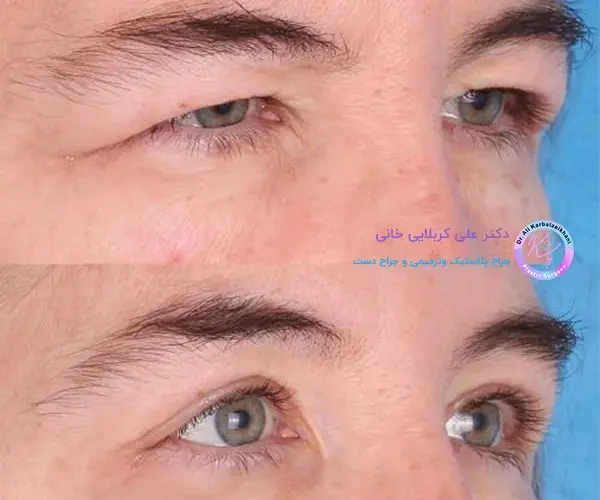 جراحی پف بالای چشم