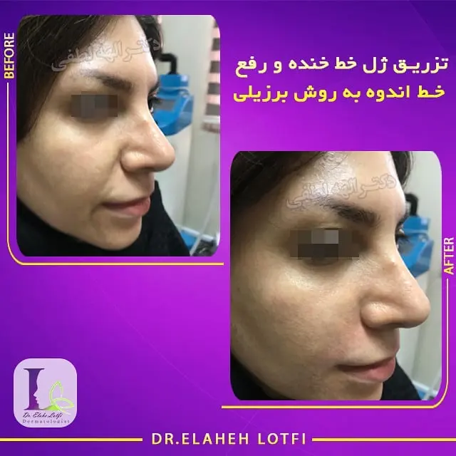 تزریق-ژل-خنده-و-رفع-خط-اندوه-به-روش-برزیلی