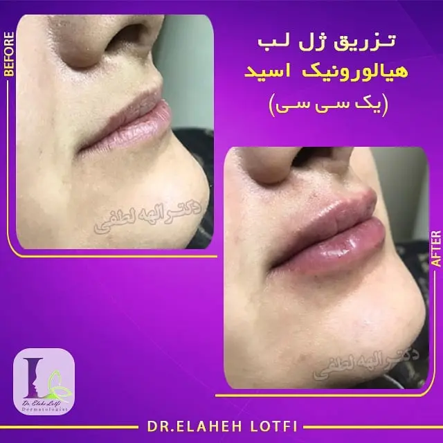 تزریق-ژل-لب-هیالورونیک-اسید-برندهای-معتبر
